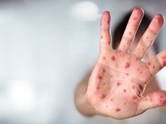 Two children die as measles outbreak hits Jacobabad’s Thul tehsil