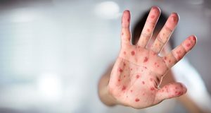Two children die as measles outbreak hits Jacobabad’s Thul tehsil