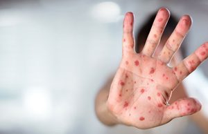 Two children die as measles outbreak hits Jacobabad’s Thul tehsil