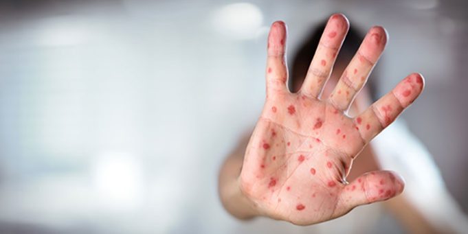 Two children die as measles outbreak hits Jacobabad’s Thul tehsil